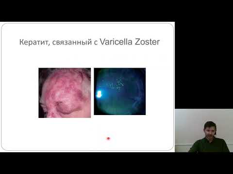 Видео: Офтальмология 2.Кератиты