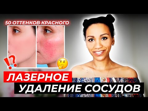 Видео: Правда про лазерное удаление сосудов//Удалить сосудистые звёздочки (купероз) и сосудистую сетку