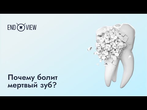 Видео: Болит зуб после удаления нерва - что делать?