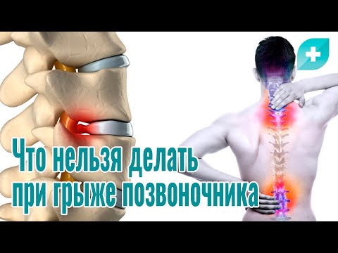 Видео: Что нельзя делать при грыже позвоночника