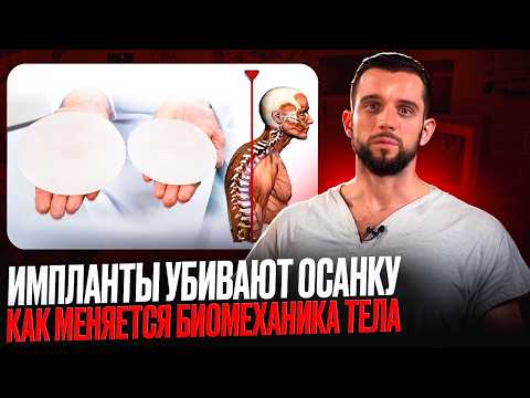 Видео: импланты ДЕЙСТВИТЕЛЬНО влияют на ОСАНКУ?