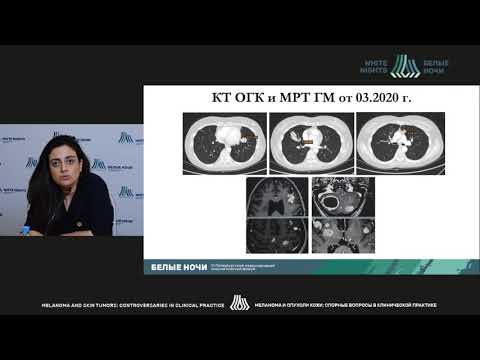 Видео: Меланома и сопутствующий анамнез: клинические случаи (Оганесян А.П.)