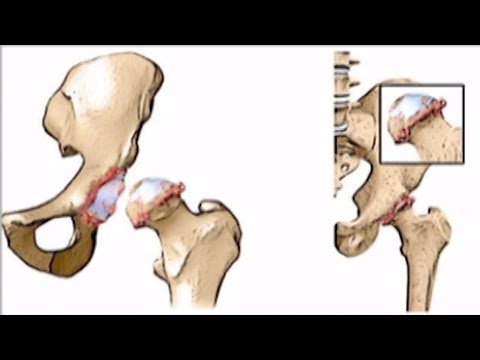 Видео: Асептична некроза на главичката на бедрената кост