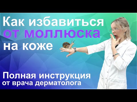 Видео: Моллюск контагиозный это/Лечение моллюска на коже у детей и взрослых