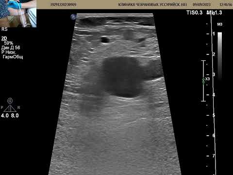 Видео: УЗИ вен. Запущенный варикоз.