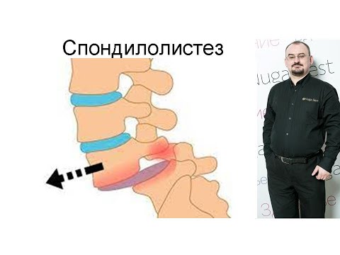 Видео: Спондилолистез – что это такое и как его лечить