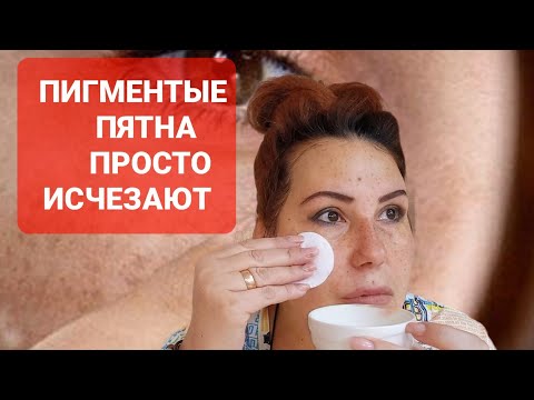 Видео: Убираю все Пигментные пятна с лица. Простая маска от пигментации.