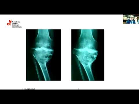 Видео: Деносумаб в лечении гигантоклеточной опухоли кости