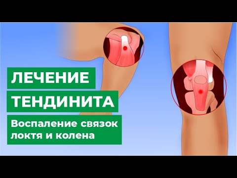 Видео: Лечение тендинита. Воспаление связок локтя и колена.