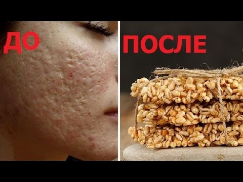 Видео: КОЗИНАКИ ИЛИ КАК АЛЬБЕРТА ПОРВАЛО