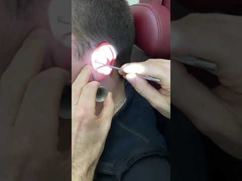 Видео: Что достали из уха?