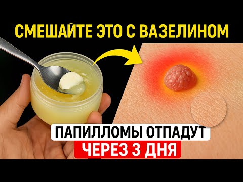 Видео: Папилломы и бородавки исчезнут сами — просто добавьте ЭТО в вазелин!