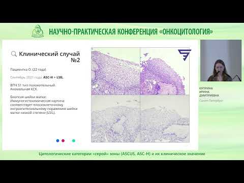 Видео: Цитологические категории «серой» зоны ASCUS, ASC H и их клиническое значение