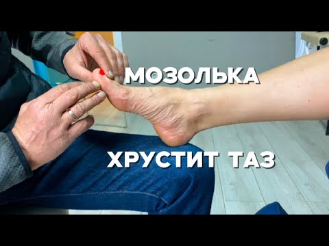 Видео: Мозоль на стопе и хруст в тазу из-за хождения в тапках