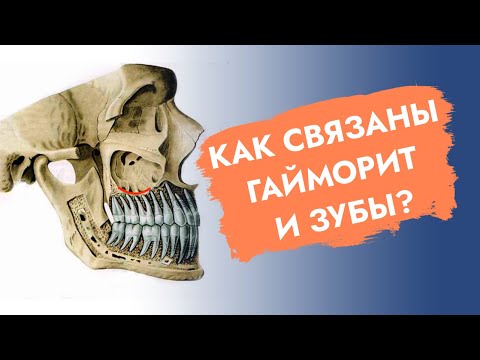Видео: Гайморит и зубы.