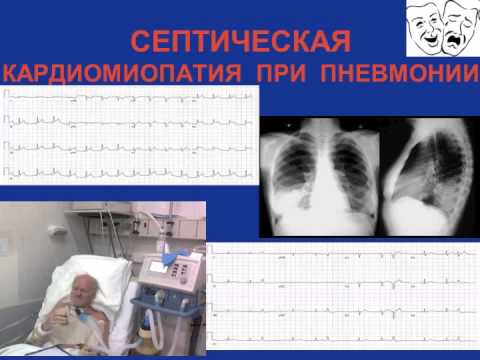 Видео: Инфаркт миокарда дифдиагностика и маски инфаркта Кошкина Е.В.