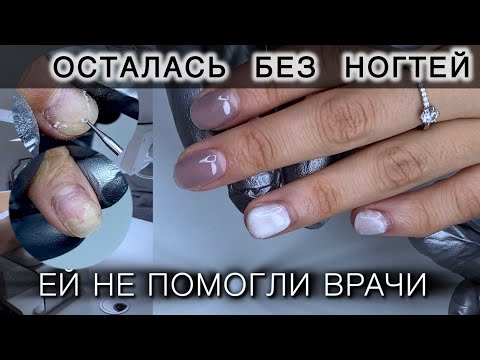 Видео: Что такое ОНИХОЛИЗИС? Псориаз ногтей , аллергия на гельлак. Когда идти к врачу?