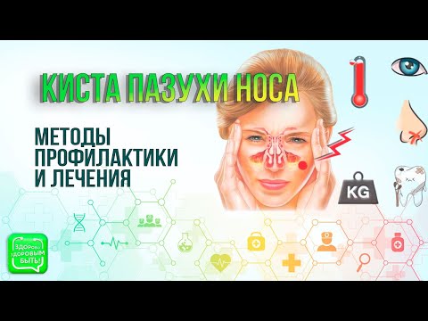 Видео: Киста носовой пазухи |  Методы лечения и профилактики