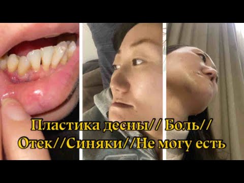 Видео: ПЛАСТИКА ДЕСНЫ//БОЛЬ//ОТЕК//НЕ МОГУ ЕСТЬ