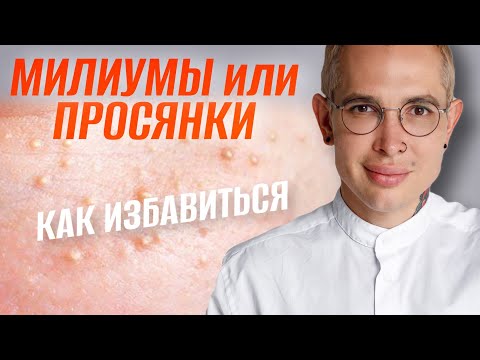 Видео: МИЛИУМЫ или ПРОСЯНКИ как избавиться в домашних условиях #подкожники #просянки