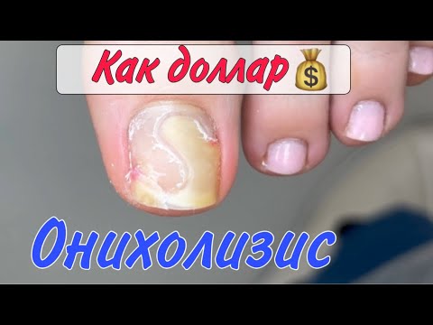 Видео: Оторвался ноготь/онихолизис/как зачистить ноготь
