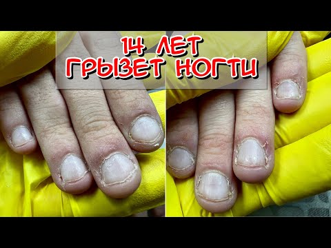 Видео: 14 лет грызет ногти / маникюр / маникюр для подростка
