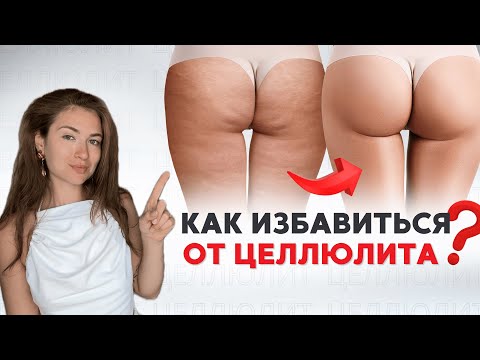 Видео: Всё про ЦЕЛЛЮЛИТ за 15 МИНУТ | Причины возникновения и методы борьбы, которые РЕАЛЬНО работают