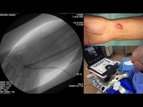 Видео: Видеопрезентация дистального лучевого доступа