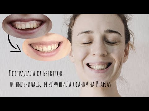 Видео: Моя история прикуса. Брекеты, Starecta, Planas, Alf. Расширение челюсти на 0,8 мм за 5 месяцев.