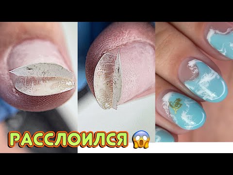 Видео: Расслоился ноготь от удара  😬 Море на ногтях / Как убрать отслойки / Маникюр