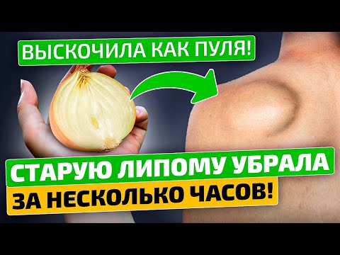 Видео: УРА! Уже думала идти к хирургу, но справилась сама! Липома (жировик) растворилась!