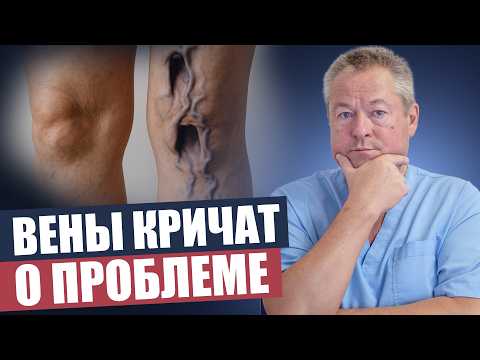 Видео: Варикозная сетка: как убрать ее навсегда без инъекций