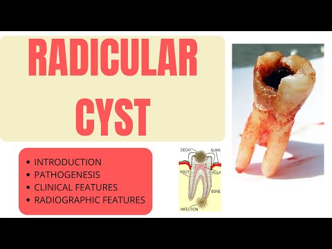 Видео: РАДИКУЛЯРНАЯ КИСТА — ЭТО ПРОСТО! ЧАСТЬ 1