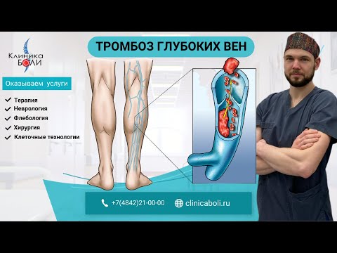Видео: ТРОМБОЗ ГЛУБОКИХ ВЕН