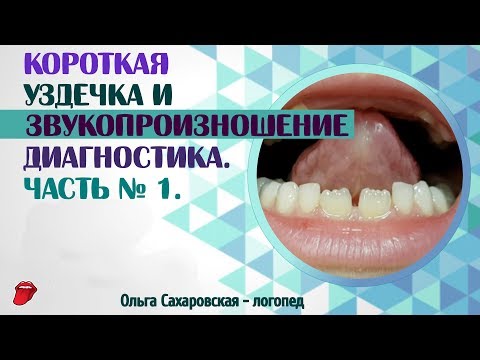 Видео: Короткая уздечка языка. Как влияет на произношение звуков? Диагностика  Часть № 1