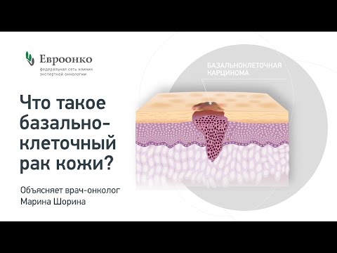 Видео: Насколько опасен базальноклеточный рак кожи? Как его лечат? Рассказывает врач-онколог Марина Шорина