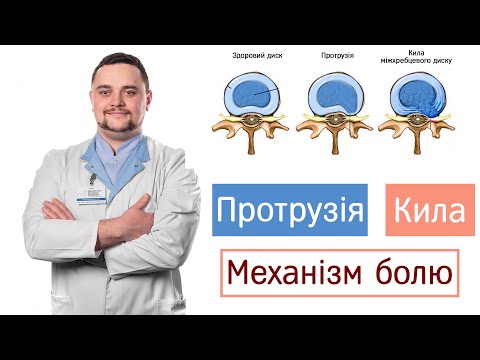 Видео: Протрузія  Грижа  Механізм Болю