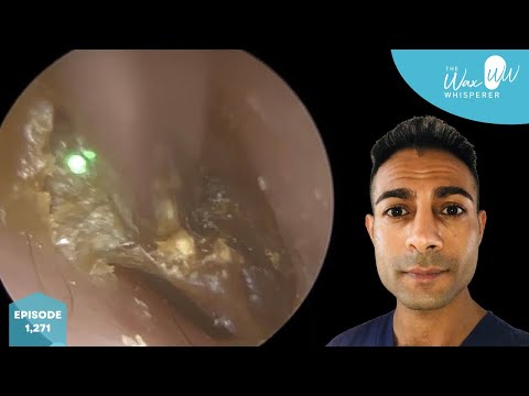 Видео: 1,271 - x2 видео об удалении ушной серы