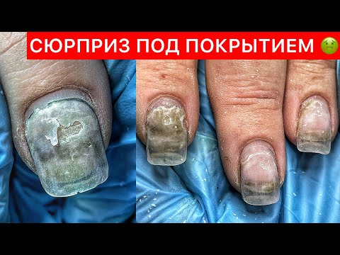 Видео: «И ТАК СОЙДЁТ»🤭 ОТСЛОЙКИ НА КАЖДОМ НОГТЕ 🤢