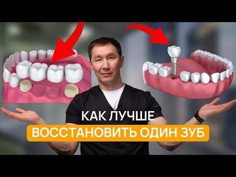 Видео: Что выбрать сегодня? МОСТ или ИМПЛАНТ? НЕПРАВИЛЬНЫЙ выбор может УНИЧТОЖИТЬ ваши зубы!
