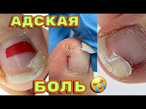Видео: Жуткая боль 😬 Запустила себя 💅 Педикюру 3 месяца