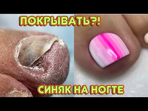 Видео: СИНЯК на ногте, покрывать? 🙄 Педикюр / Наращивание на ногах