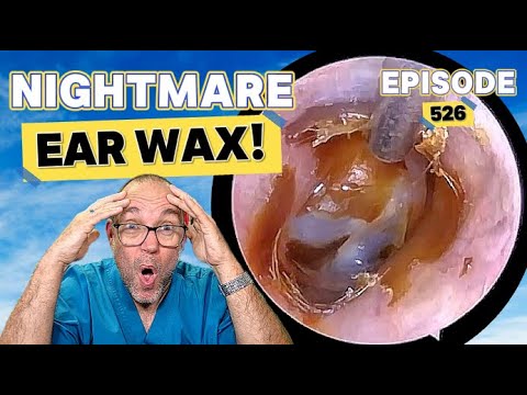 Видео: Кошмарная ушная сера! Эпизод 526 (и у меня БОЛЬШИЕ НОВОСТИ!)