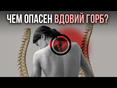 Видео: ЧЕМ ОПАСЕН ВДОВИЙ ГОРБ ИЛИ ХОЛКА? разбор от Георгия Темичева