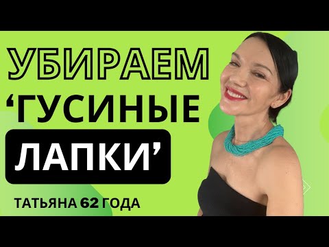 Видео: КАК УБРАТЬ "ГУСИНЫЕ ЛАПКИ" /МОРЩИНЫ У УГОЛКОВ ГЛАЗ БЕЗ БОТОКСА