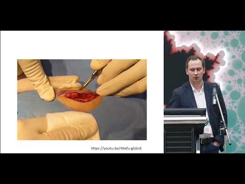 Видео: Техники биопсии меланомы