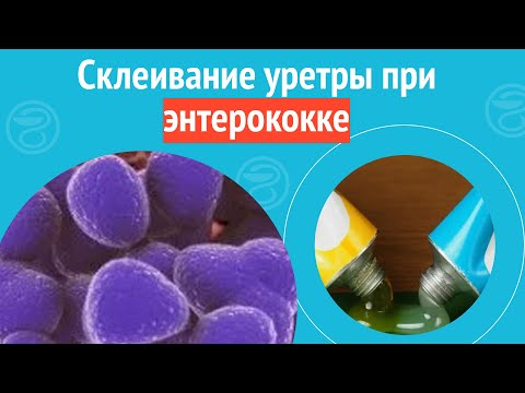 Видео: 😲 Склеивание уретры при энтерококке. Клинический случай №1167