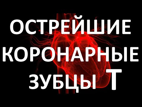 Видео: ОСТРЕЙШИЕ КОРОНАРНЫЕ Т: ПЕРВЫЙ ЭКГ ПРИЗНАК ИНФАРКТА МИОКАРДА