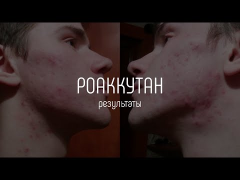 Видео: Что со мной сделал РОАККУТАН? Правда про изотретиноин.