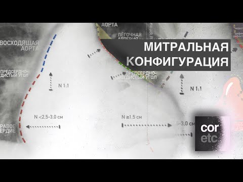 Видео: Рентген сердца: Синдром митральной конфигурации сердца.